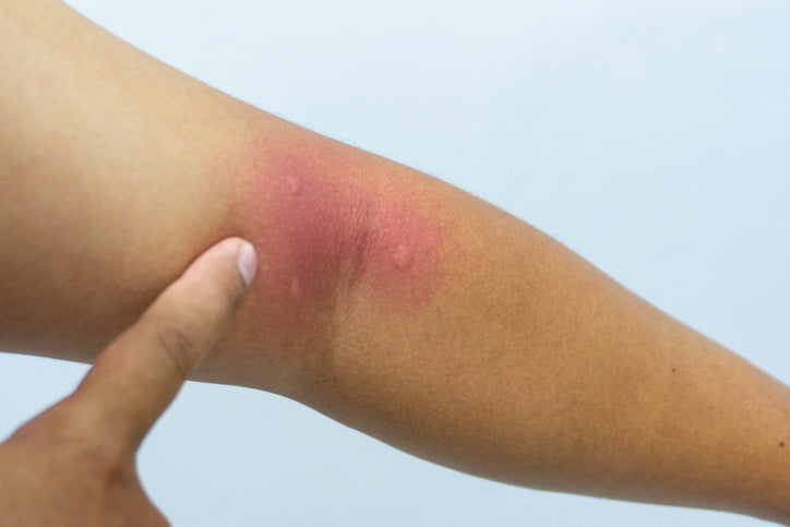 Insect bite on human skin. Swollen mosquito bite. man hand skin turned and scratching bitten